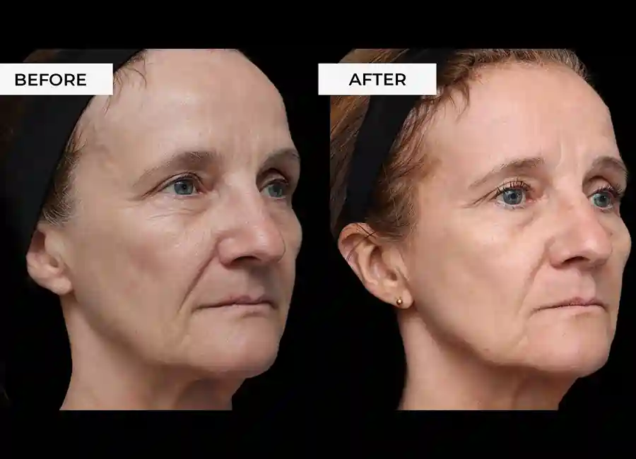 How Many RF Microneedling Sessions Will You Need to See a Difference Horsham?