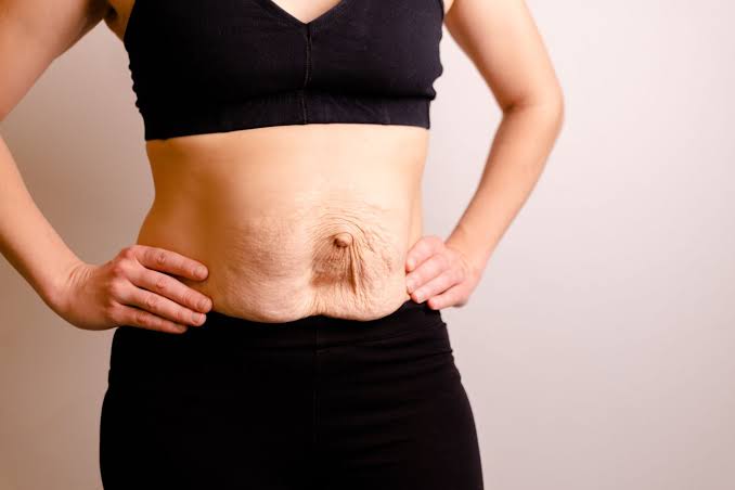 Is Surgery Really the Only Way to Repair Diastasis Recti Horsham?