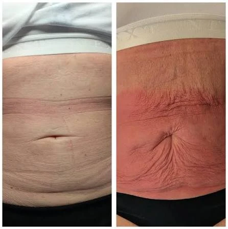 How Does RF Microneedling Improve Crepey, Thin and Uneven Skin Texture Horsham?