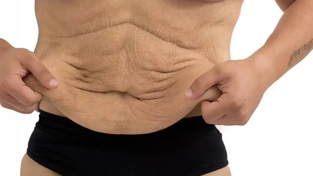 RF Microneedling for Loose Skin: How Can It Help Tighten and Reshape the Skin Horsham?